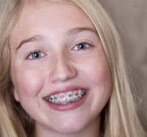 traditional braces