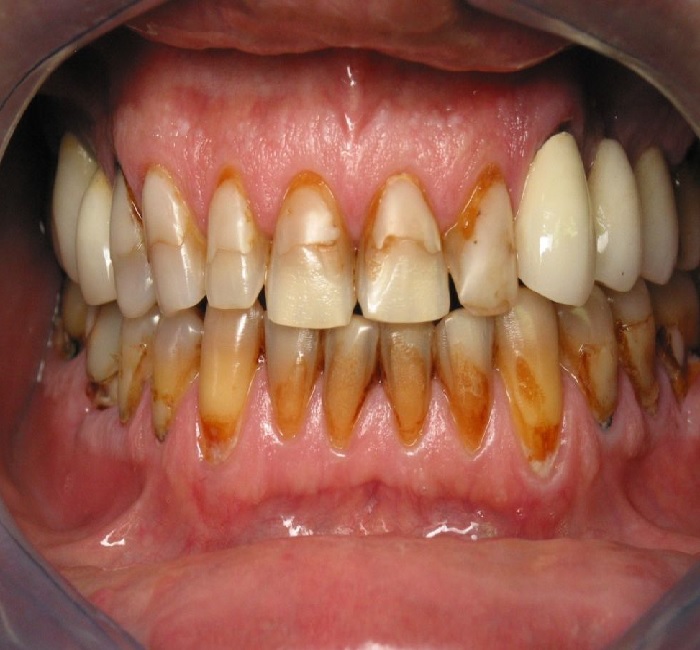 discolored teeth