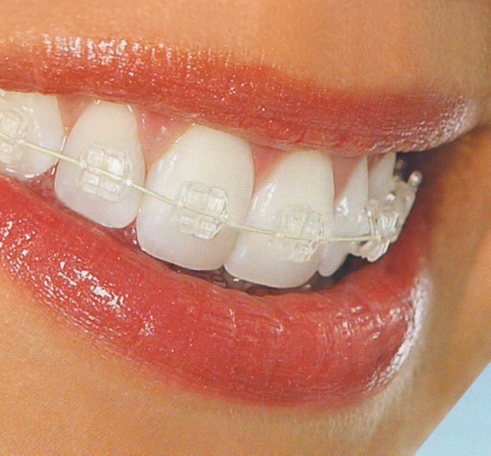 cosmetic braces