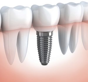 dental implant