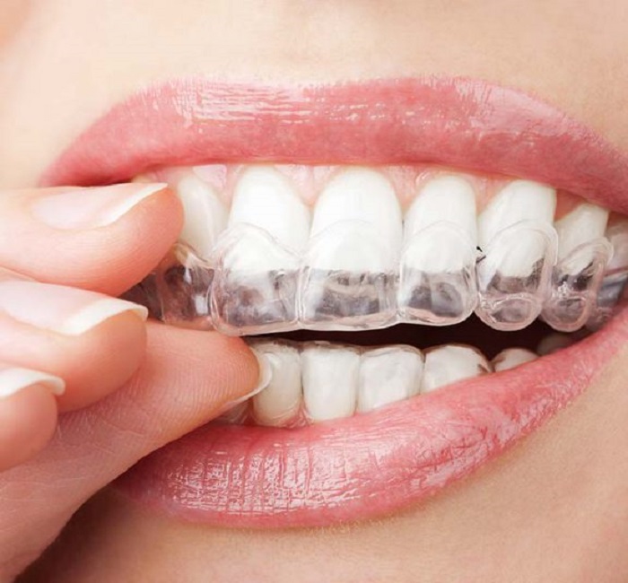 clear aligners