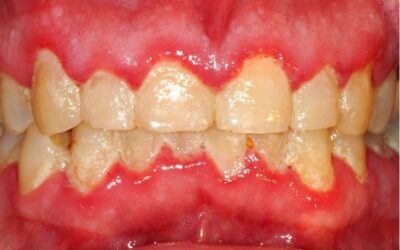What is gingivitis? Explained here.