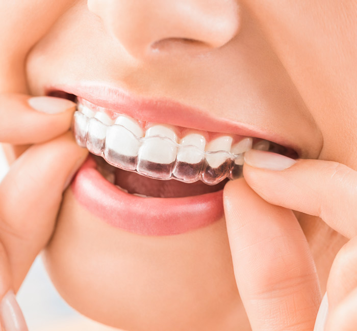 Crooked-Teeth-img