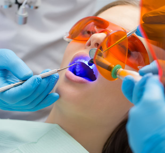 Silver-Fillings-img