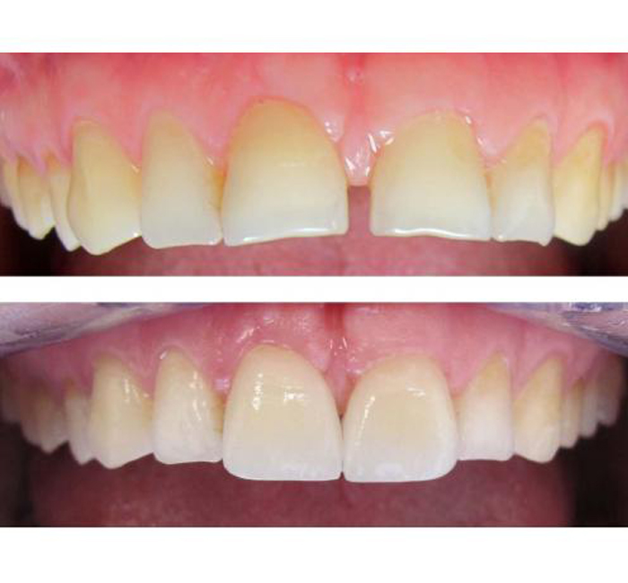 Dental Bonding in Croydon | Divine Dental Care Dental Bonding Croydon