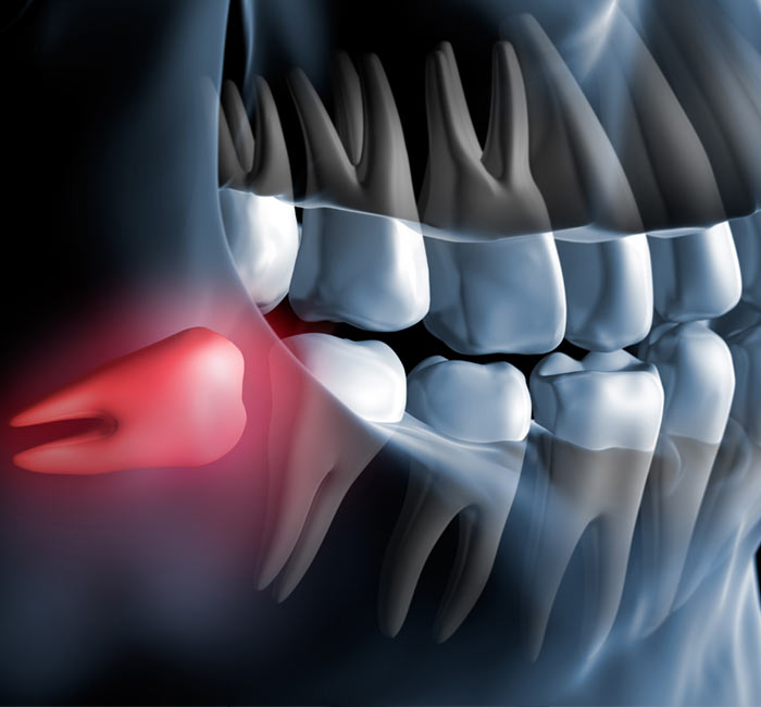 Wisdom-Teeth-Removal-img
