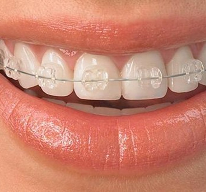 ceramic_braces-img