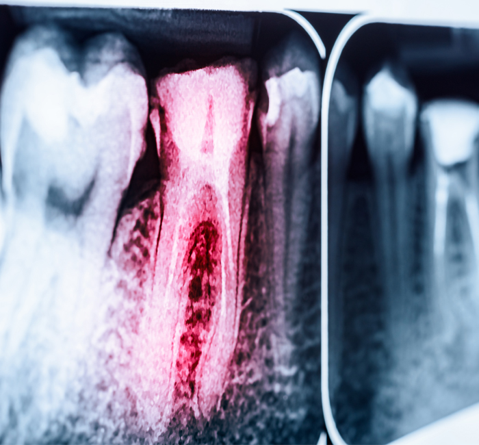 root-canal-img