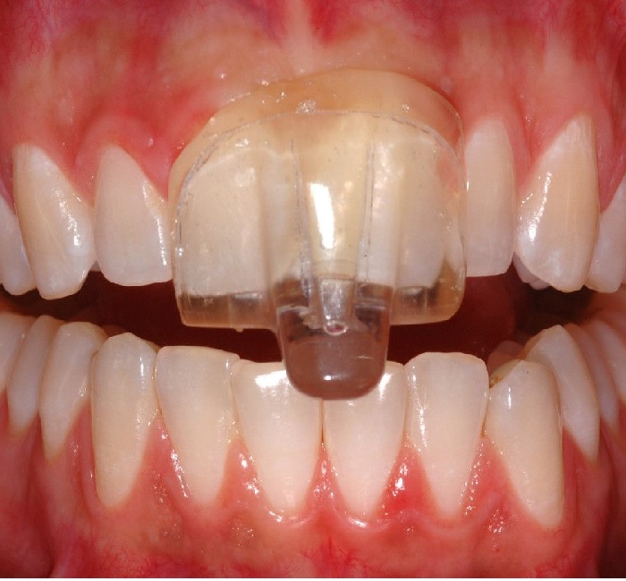 teeth-grinding-splints-img