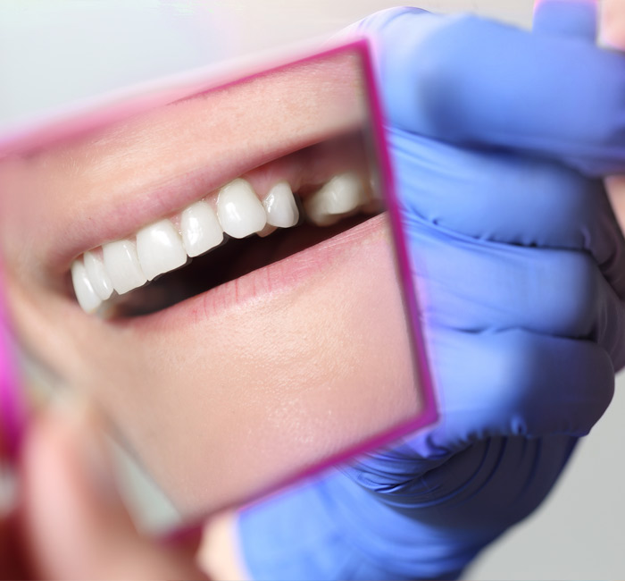 Missing-Teeth-img