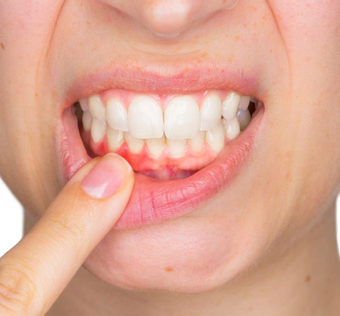 gum-disease-img